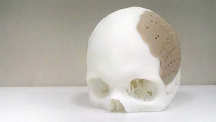 Skull replaced with a 3D-printed plastic prosthetic