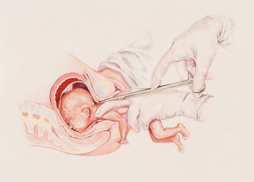 This image shows a partial-birth abortion, which is illegal in the US. It is, however, the exact procedure described to be cared out by the director of Planned Parenthood. Credit: LiveActionNews