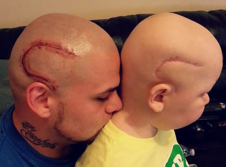 Dad Supports Son By Tattooing Cancer Scar On His Head