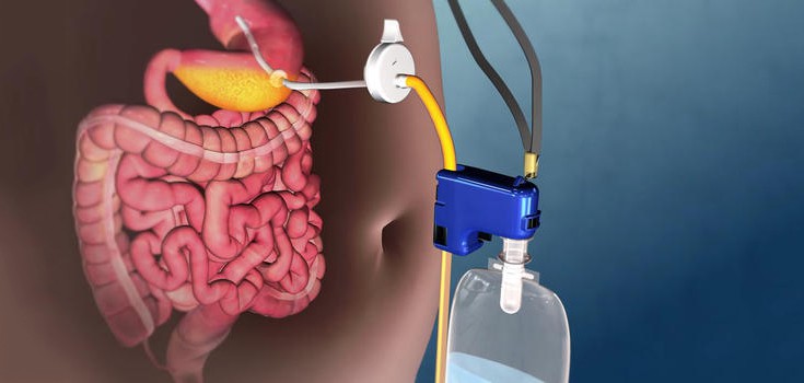 Stomach Pump Device For Weight Loss Approved By FDA