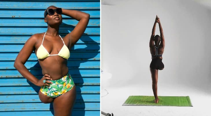 Amputee Fashion Blogger Becomes Internet Sensation Due To Bold Self-Acceptance