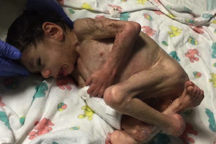 Family Adopts Child Near Death And Now He Is Completely Unrecognizable [Photos]