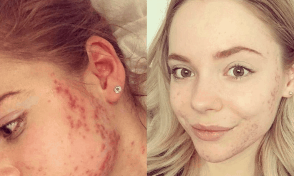 Beauty Queen Finalist Says This Eco-Friendly Diet Cleared Her Cystic Acne