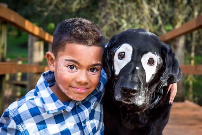 Boy With Rare Skin Disorder Was Ashamed Of His Look… Until He Met This Dog!
