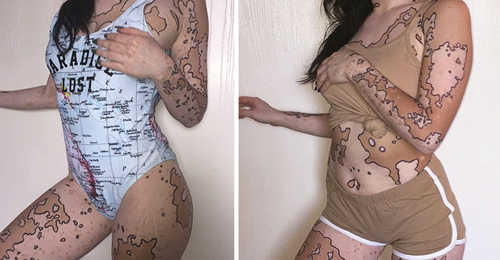 Woman Once Bullied For Vitiligo Now Uses The Unique Markings To Create Amazing Art