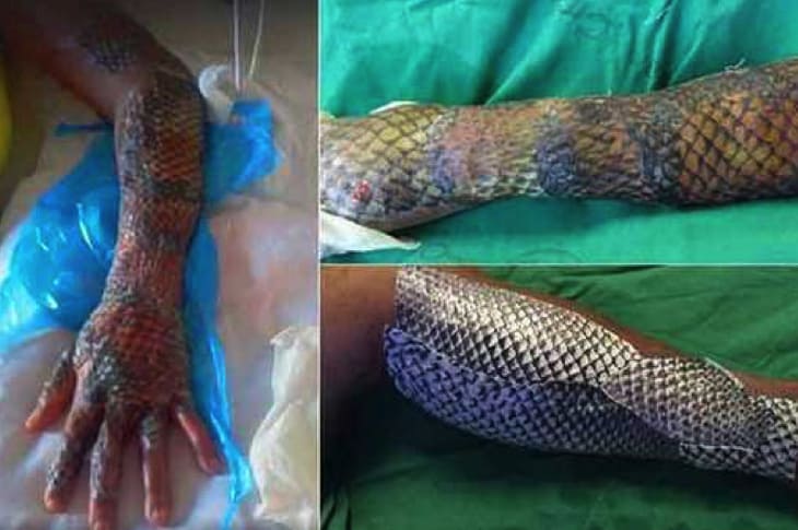 Burn Patients Are Healing Faster With Less Pain Thanks To Fish “Gauze”