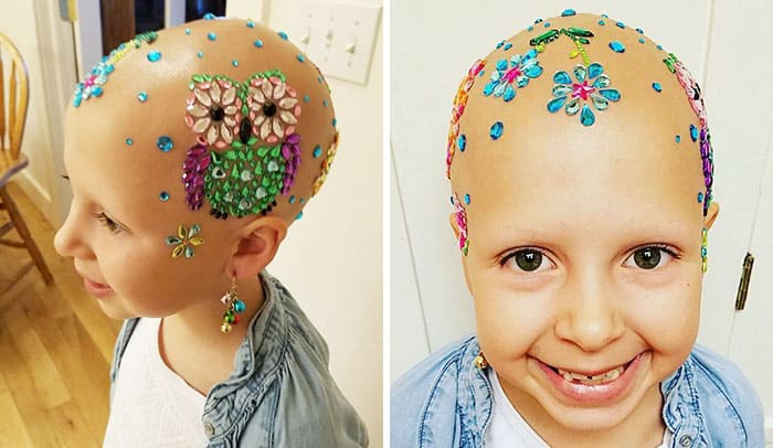7-Year-Old With Alopecia Dazzles Her School On Crazy Hair Day