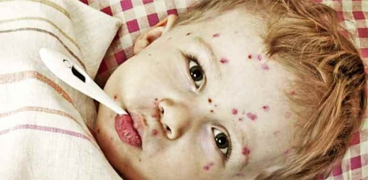 School Bans Unvaccinated Kids After Immunized Children Start Outbreak Of Chickenpox