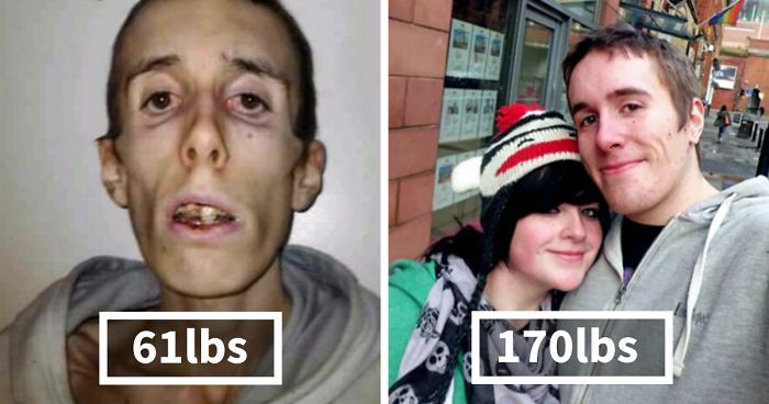 45 ‘Before & After’ Photos Of People Who Beat Anorexia