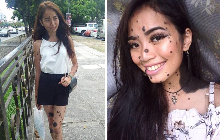 Woman Called ‘Monster’ For Having Head-To-Toe Moles Could Be The Next Miss Universe