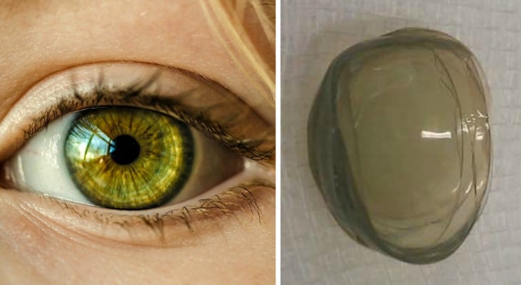 67-Year-Old Woman Had 27 Contact Lenses On Her Eye And Just Found Out