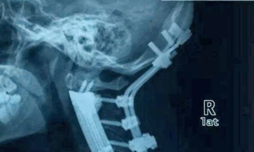 Amazing! Surgeons Replace Six Neck Bones With 3D-Printed Spine
