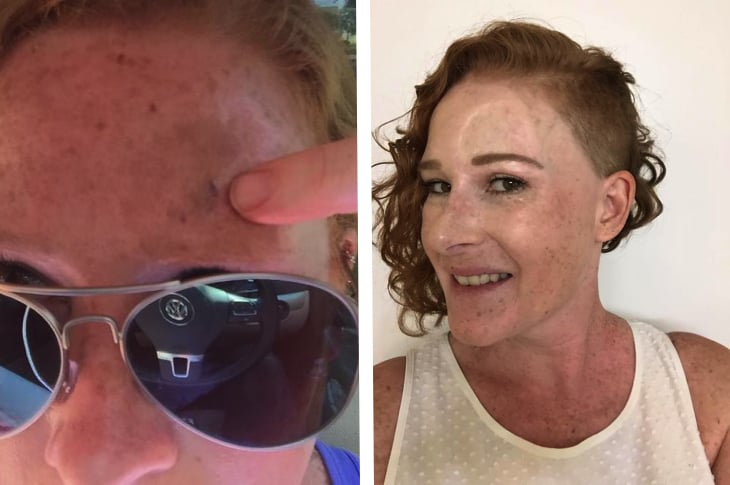 Survivor’s Story Is Encouraging People To Put On Sunscreen And Cut Out Tanning