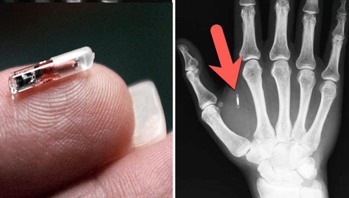 Thousands In Sweden Have Implanted Microchips Under Their Skin