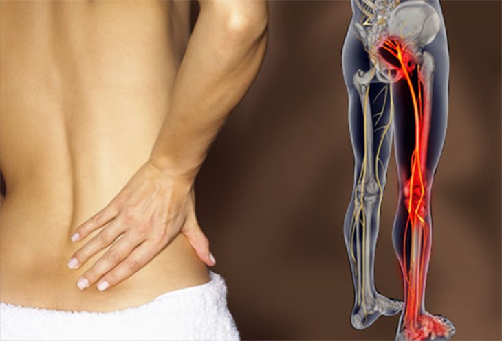 Sciatica – What You Need to Know And How To Deal With It
