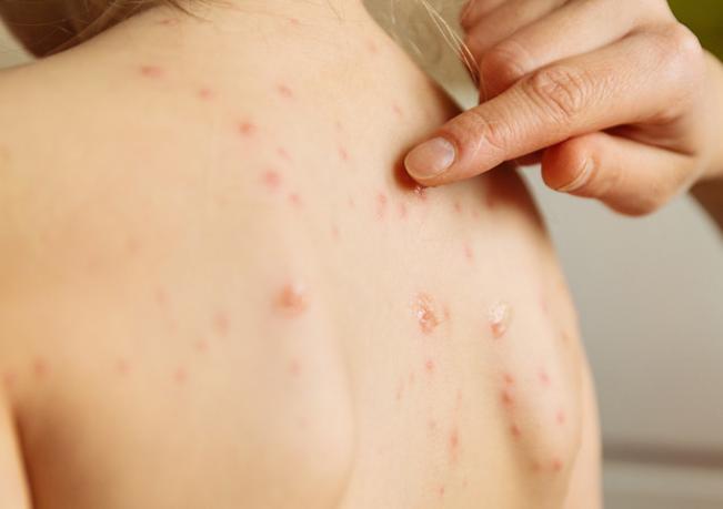 Measles Outbreak In Washington State Makes Governor Declare A State Of Emergency