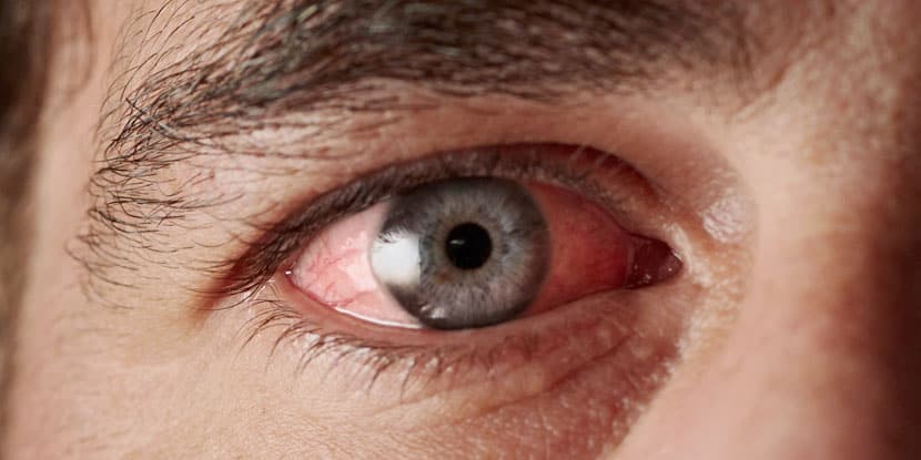 Home Remedies For Getting Rid Of Pink Eye