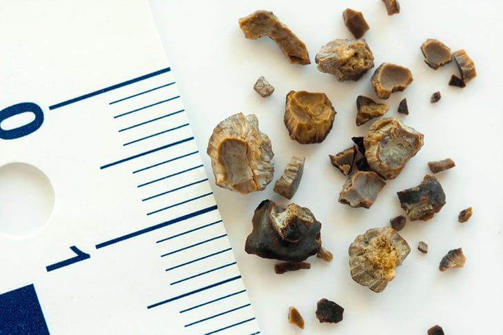 17 Ways to Identify Kidney Stones: The Signs and Symptoms Of Nephrolithiasis
