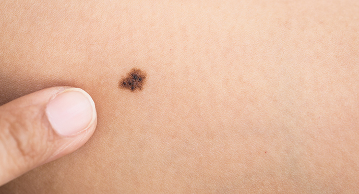 15 Signs And Symptoms Of Melanoma